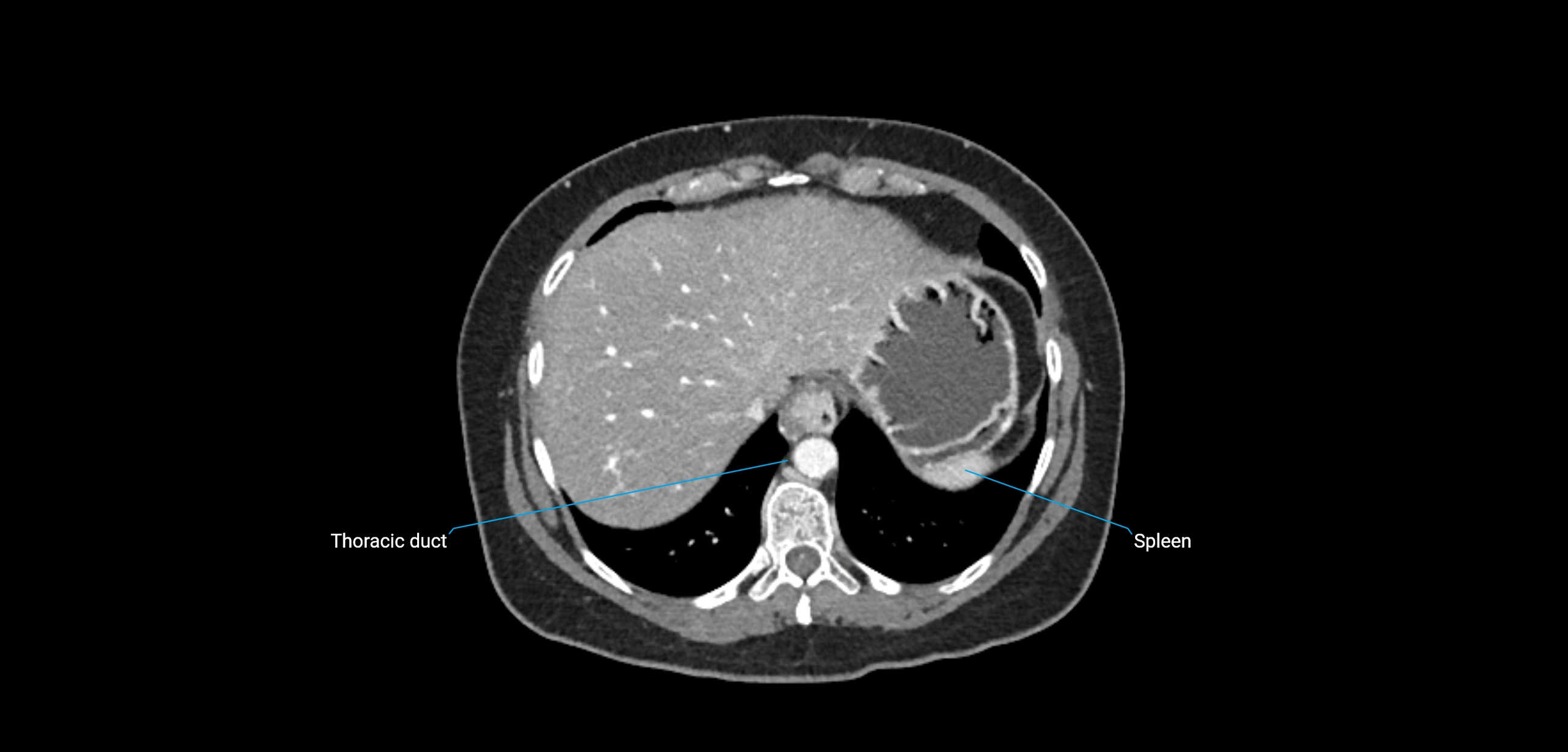 CT ct abdominal lymph nodes  axial cross sectional anatomy  enchanced radiology image -img-00002-00081.webp